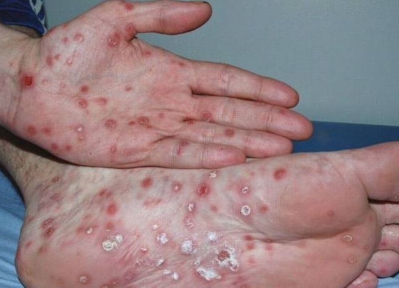 La ciudad, en alerta por el avance de la sífilis: los números que preocupan